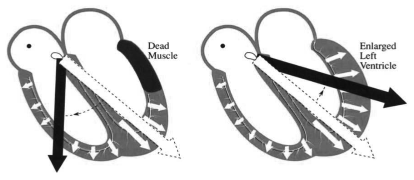 Changes in V show dead muscle and overworked muscle