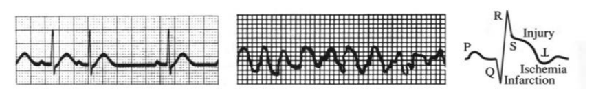 Doubtful rhythm, serious fibrillation, and signals of a heart attack